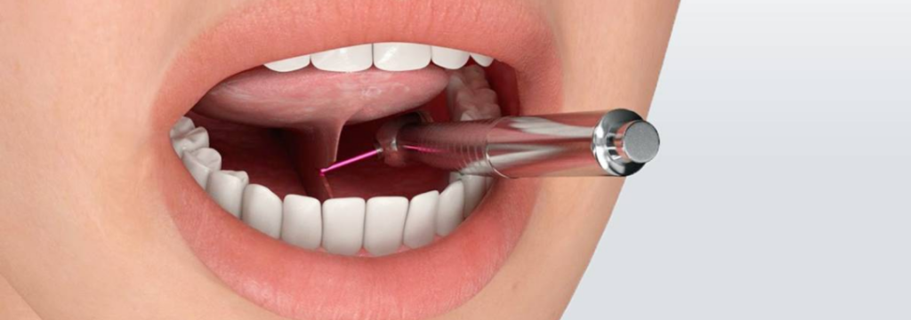 Особенности лазерной пластики уздечки языка и губы